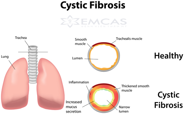 Ảnh 3 của Cystic fibrosis